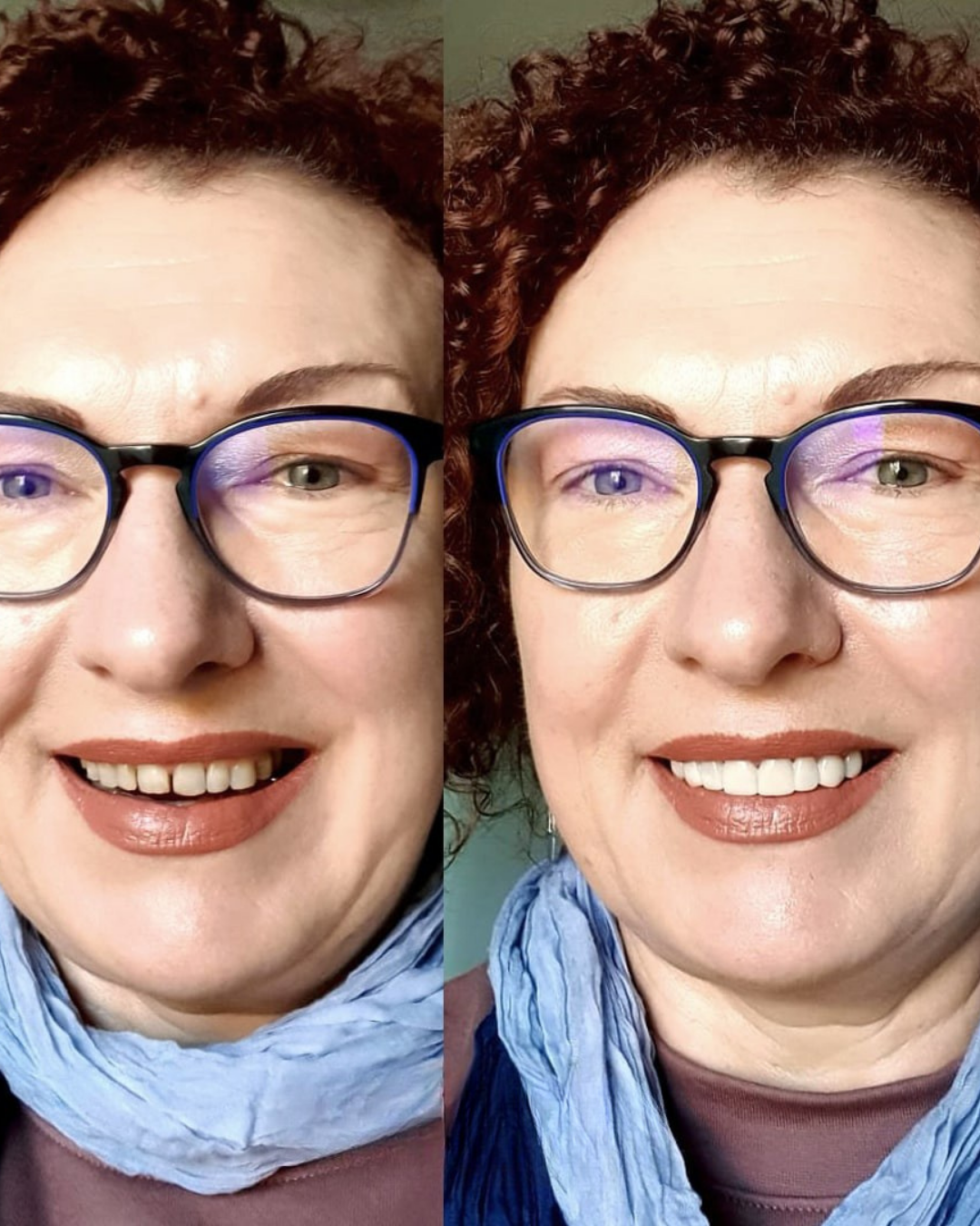 Solenadent Takma Diş