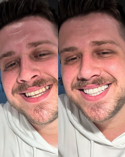 Solenadent Takma Diş